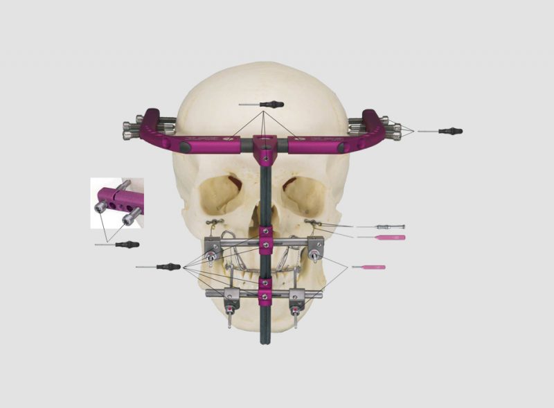 Rigid External Distraction RED II System – pshp