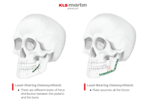 load-bearing osteosynthesis vs load-sharing osteosynthesis-kls martin