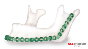 locking recontruction plate 2.7-kls martin