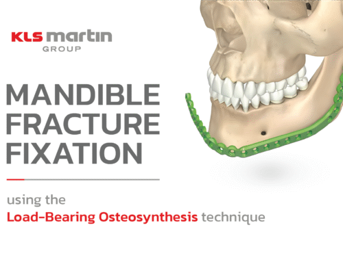 การยึดตรึงกระดูกขากรรไกรล่าง ด้วยเทคนิค Load-Bearing Osteosynthesis