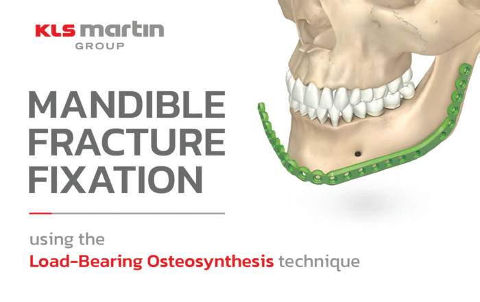 mandible fracture fixture kls-martin